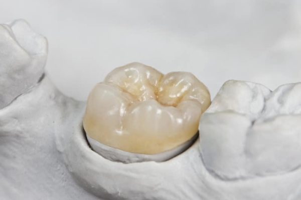 Semi Precious alloy full cast crown tooth
