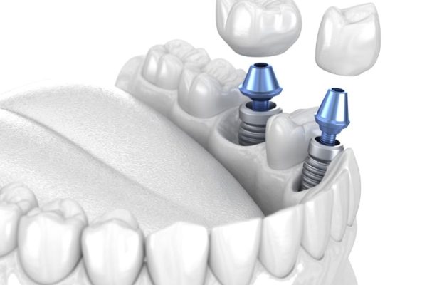 cement retained implant