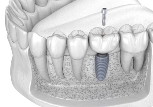 dental crown installation of screw retained implant