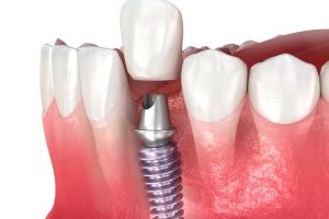 titanium abutment dental implant 3D illustration